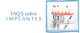 faqs sobre implantes clínica odontológica integral miguel lópez lora