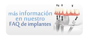 implantes informacion faq carga inmediata clínica miguel lópez lora