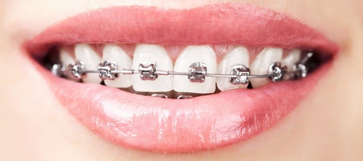 ¿Qué sistema de ortodoncia debería elegir?