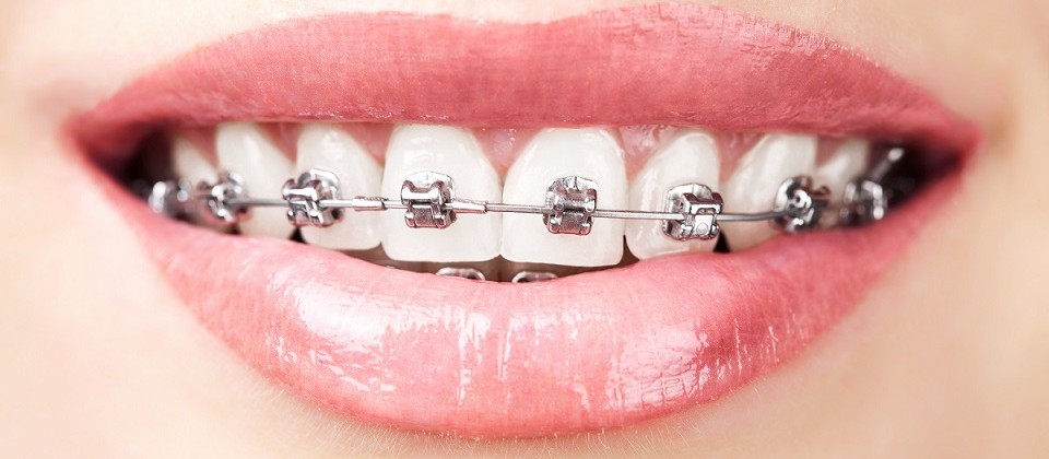 ¿Qué sistema de ortodoncia debería elegir?