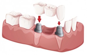 Puente dental