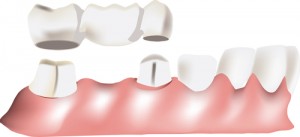 puente dental